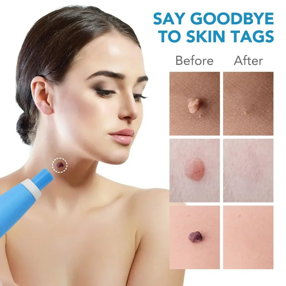 2 In1 Painless Auto Skin Tag Mole Wart Removal Kit
